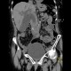 Choledocholithiasis, bile duct stones: CT - Computed tomography